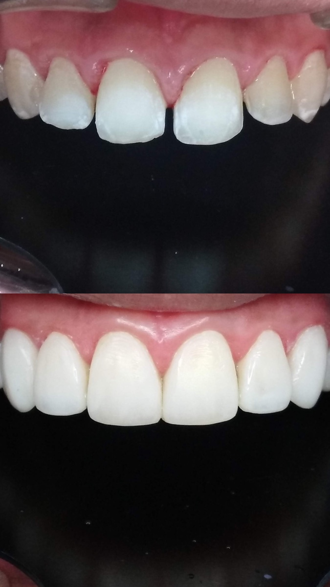 Composite resin veneer diastema closure — before and after, Dra. Paola Chicue Cali