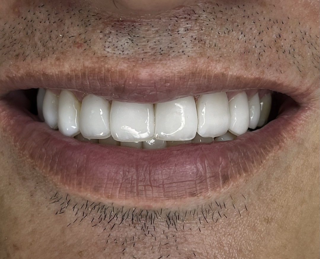 Hand-layered composite resin veneers — finished anatomy and symmetry, Dra. Paola Chicue Cali