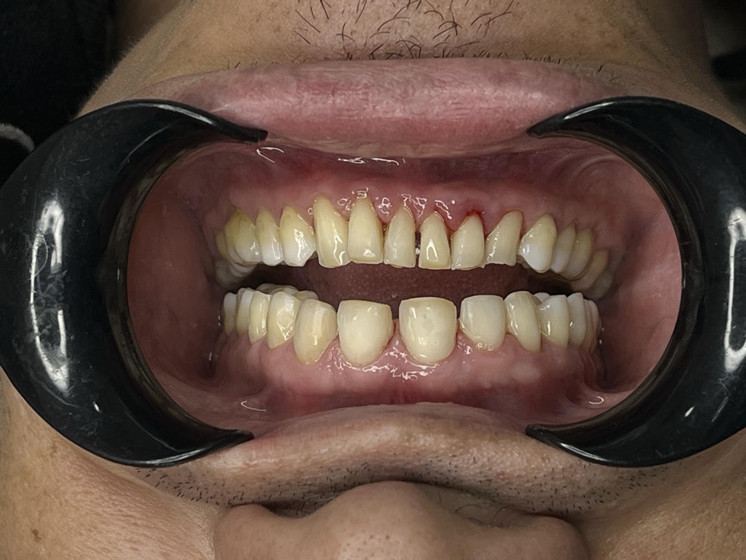 Composite veneers — before treatment (case 2), Dra. Paola Chicue Cali