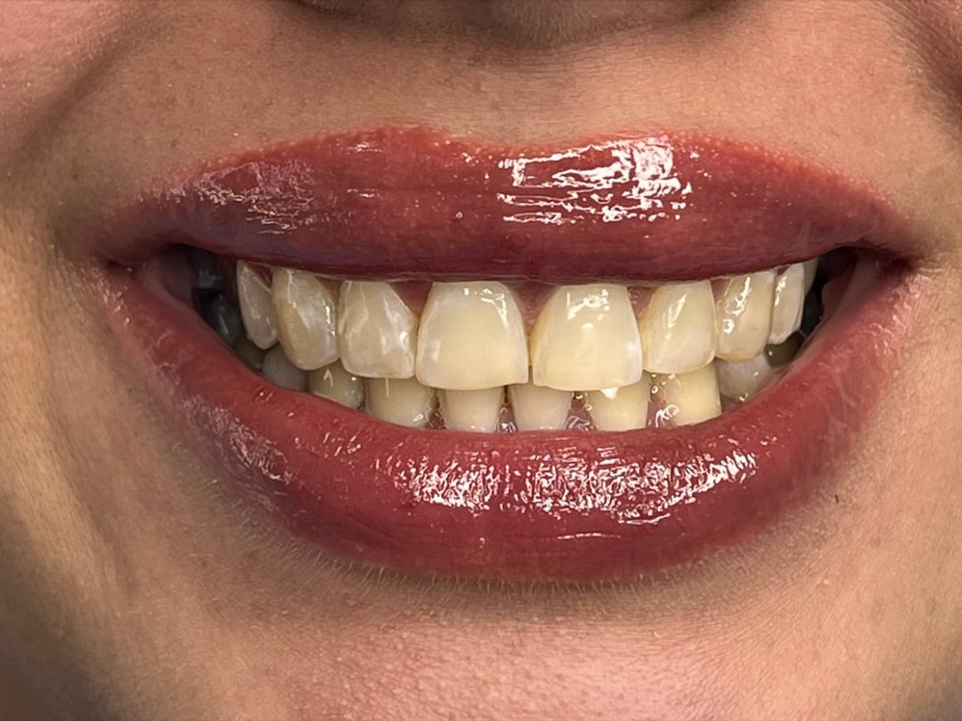 Composite veneers — before treatment (case 1), Dra. Paola Chicue Cali