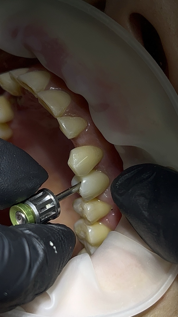 Final crown placement and torque adjustment on a dental implant — Dra. Paola Chicue Cali