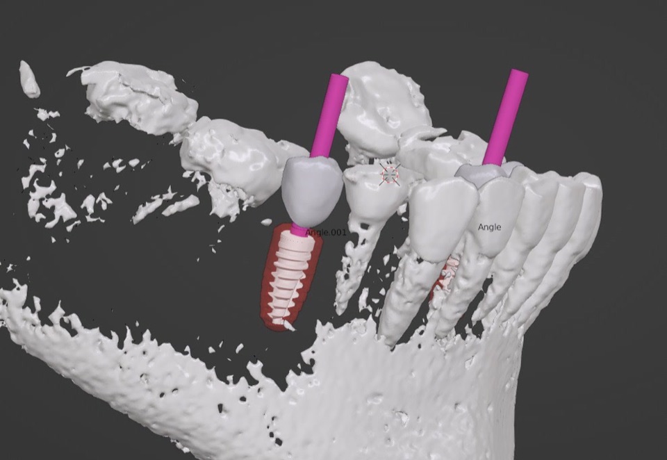 3D digital implant planning visualization showing implant trajectory and crown design — Dra. Paola Chicue Cali