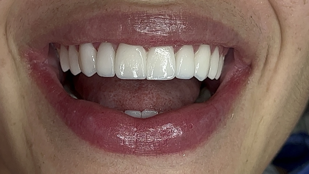 Porcelain veneers — after treatment (case 2), Dra. Paola Chicue Cali