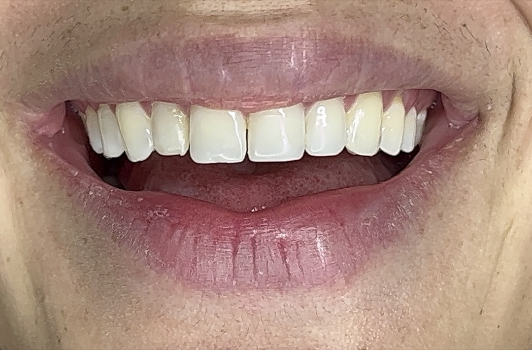 Porcelain veneers — before treatment (case 2), Dra. Paola Chicue Cali