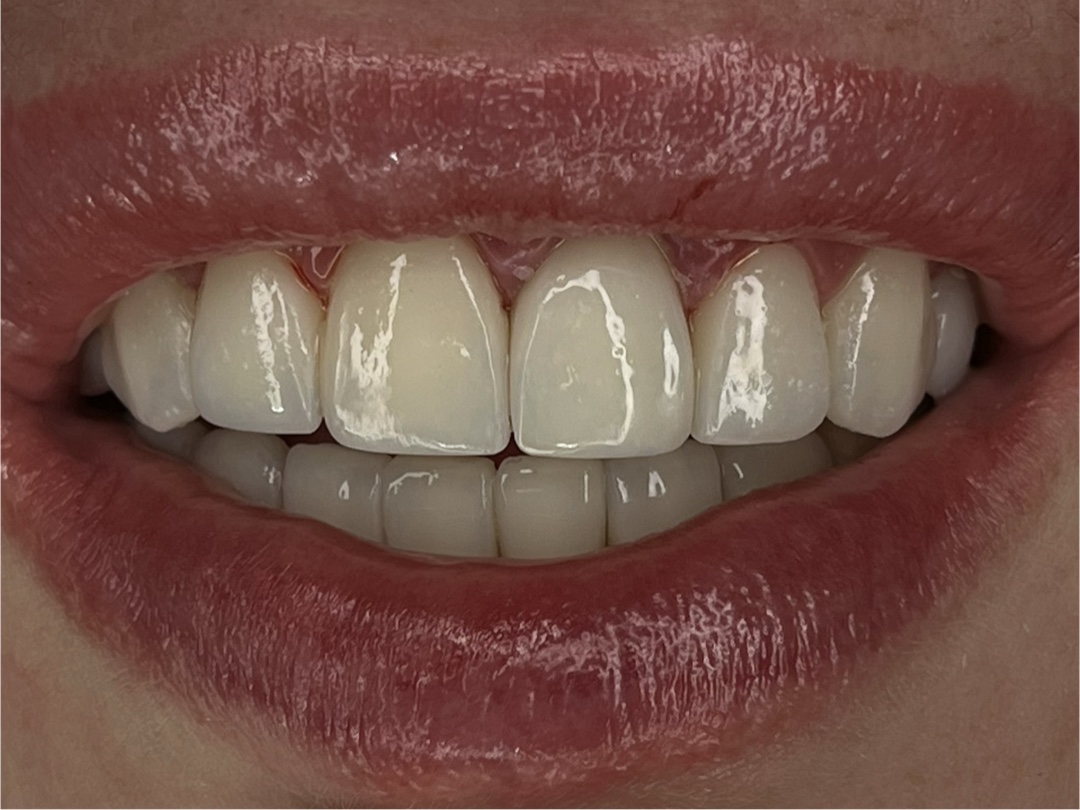 Porcelain veneers — after treatment (case 3), Dra. Paola Chicue Cali