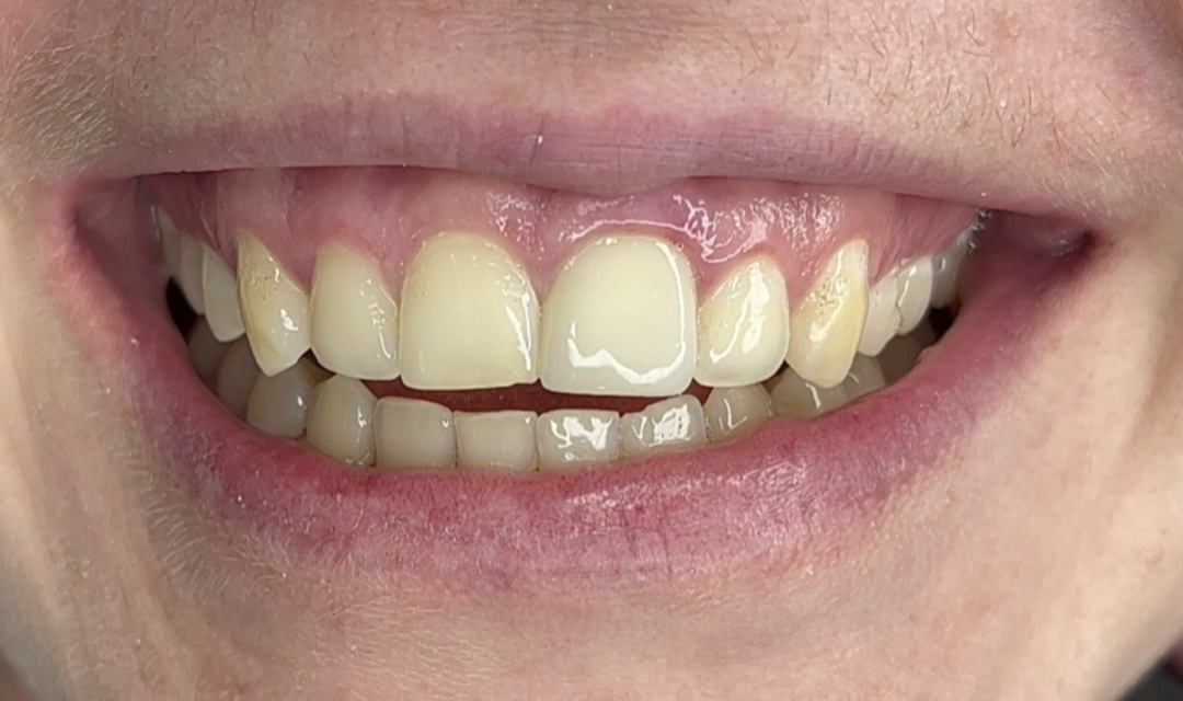 Porcelain veneers — before treatment (case 3), Dra. Paola Chicue Cali