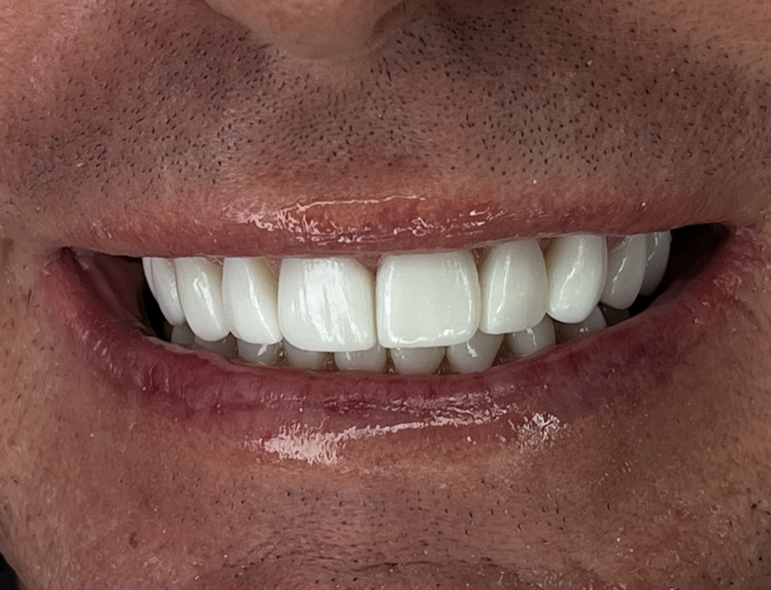 Porcelain veneers — after treatment (couple's case), Dra. Paola Chicue Cali