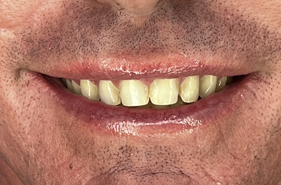 Porcelain veneers — before treatment (couple's case), Dra. Paola Chicue Cali